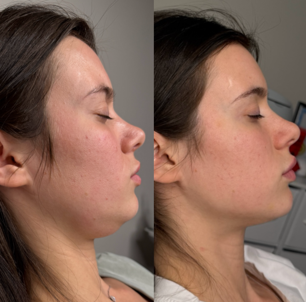 Fat dissolving treatment before and after