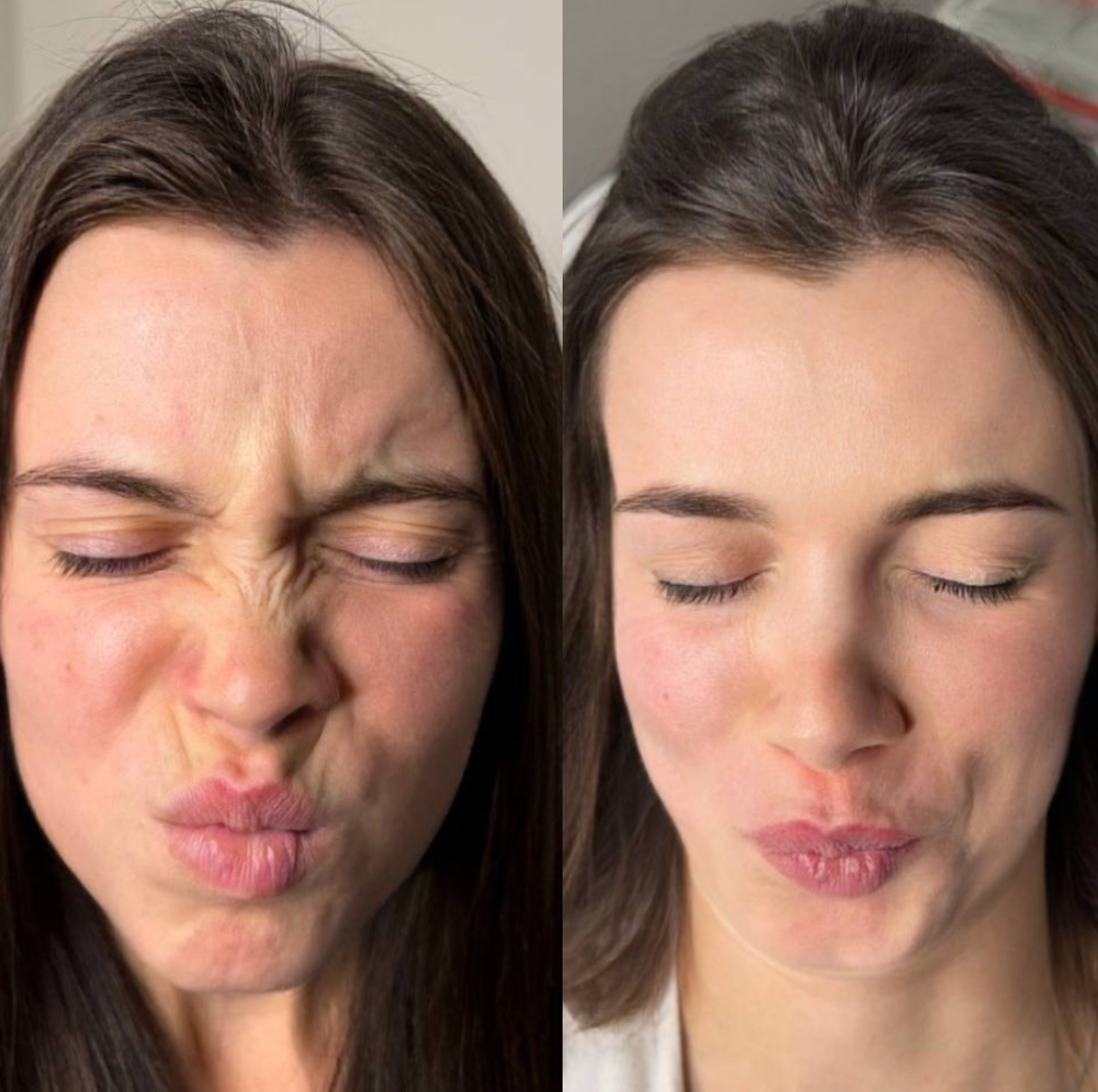 Forehead Botox before and after - result 2