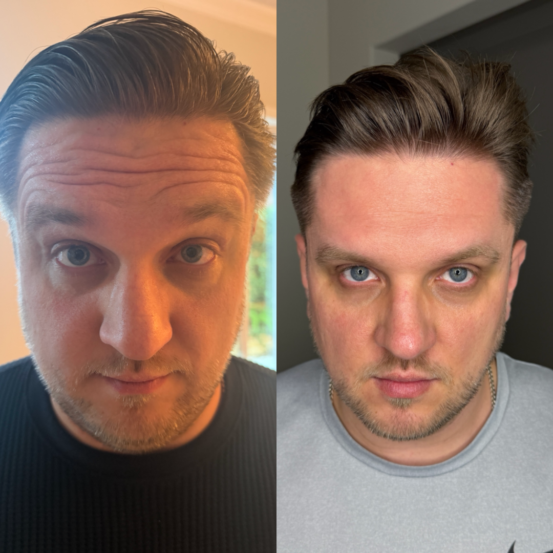 Forehead Botox before and after - result 3