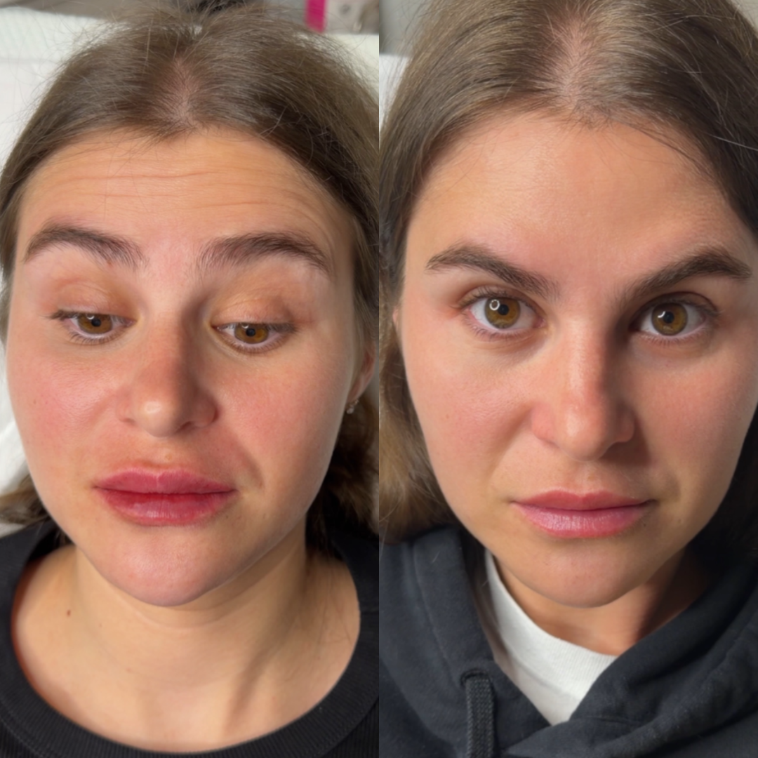 Forehead Botox before and after - result 1