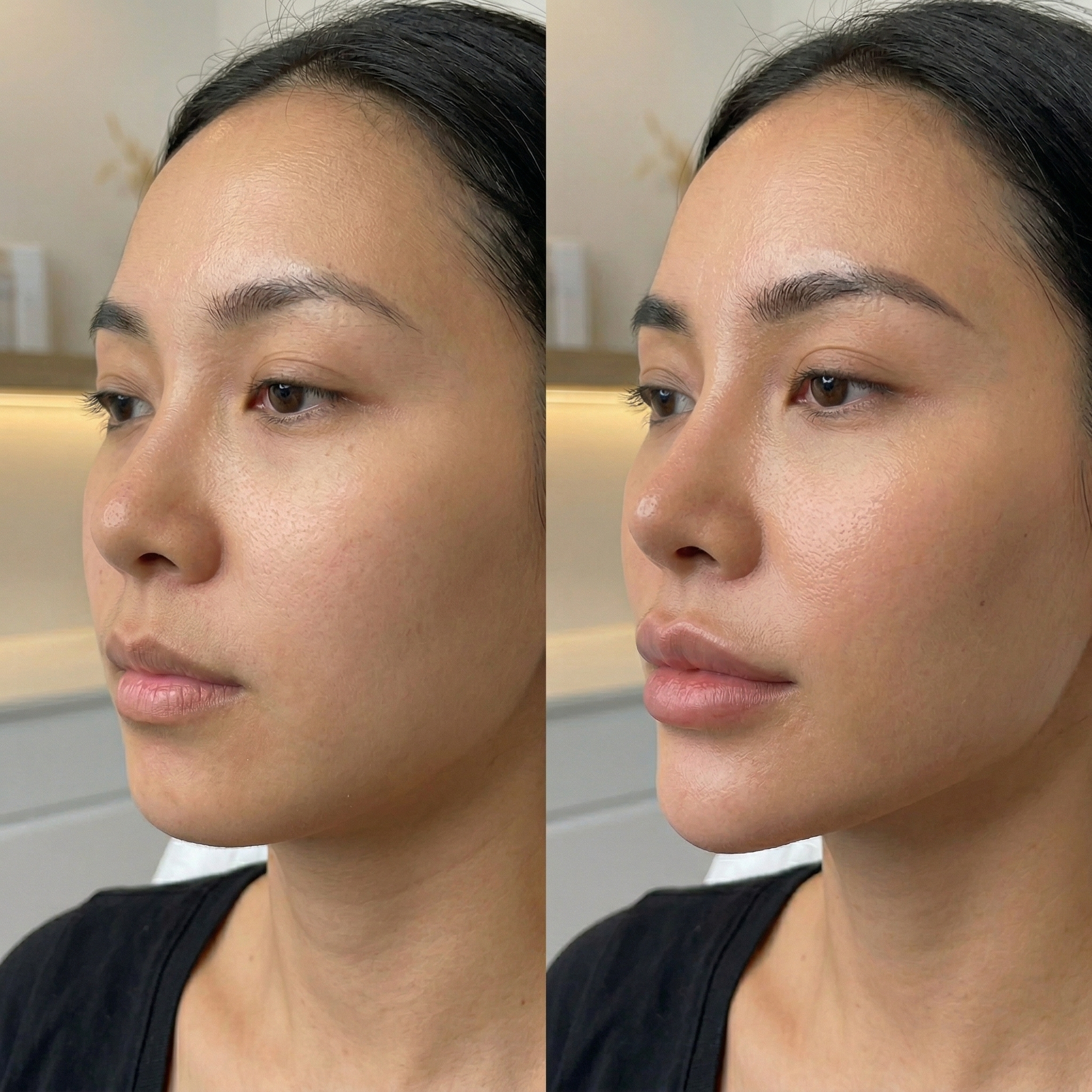 Jawline definition with filler before and after
