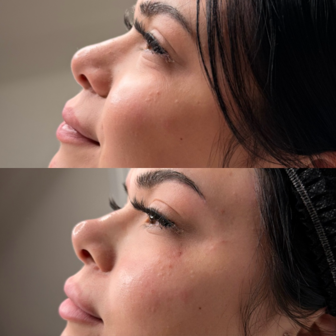 Nasal tip correction with filler before and after